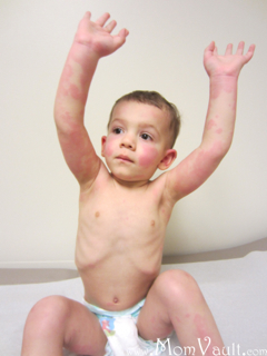 penicillinallergy penicillinallergy