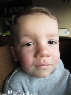 Sunscreen Allergy Dermnet Nz